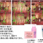 フッ化物洗口（毎日）とフッ素塗布（ほぼ毎週）で虫歯の進行抑制　001